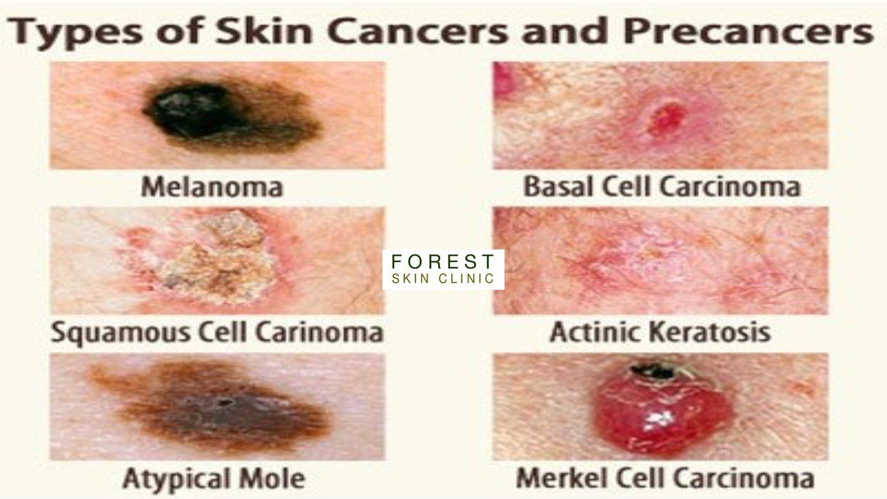 Forest Skin Clinic Skin Cancer
