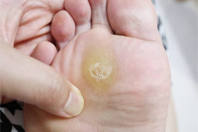 Corns and calluses removal Manchester