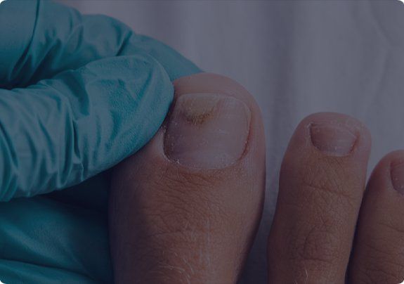 Damaged and Thickened Nails Manchester