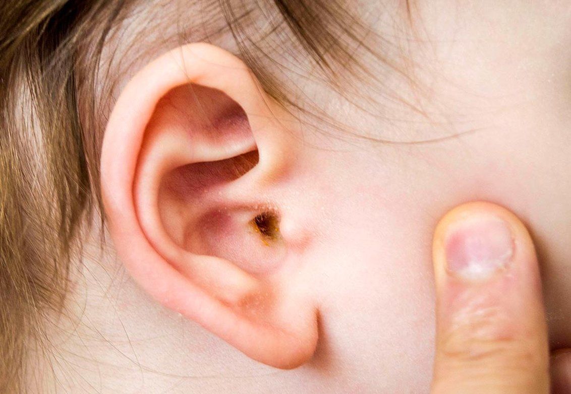 Ear Eax Removal