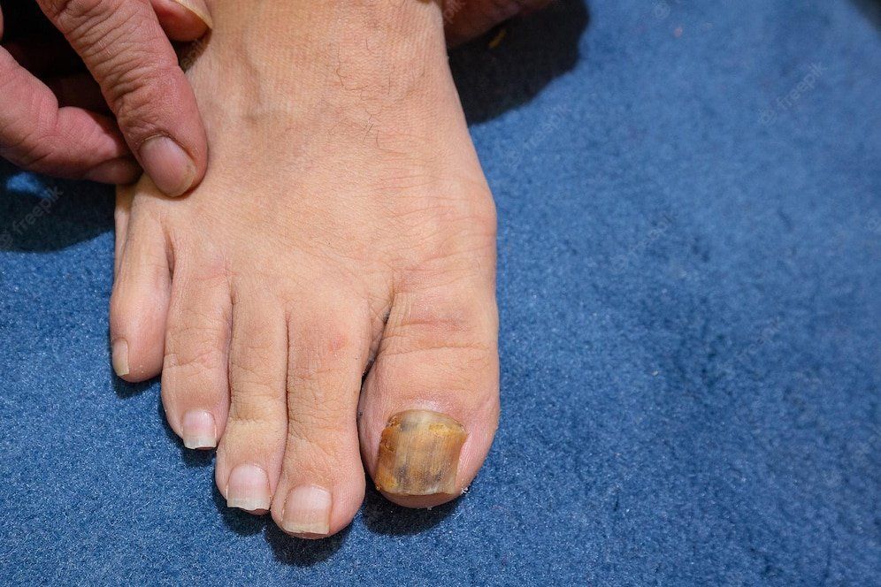 Big toe person suffering from onychomycosis fungal infection