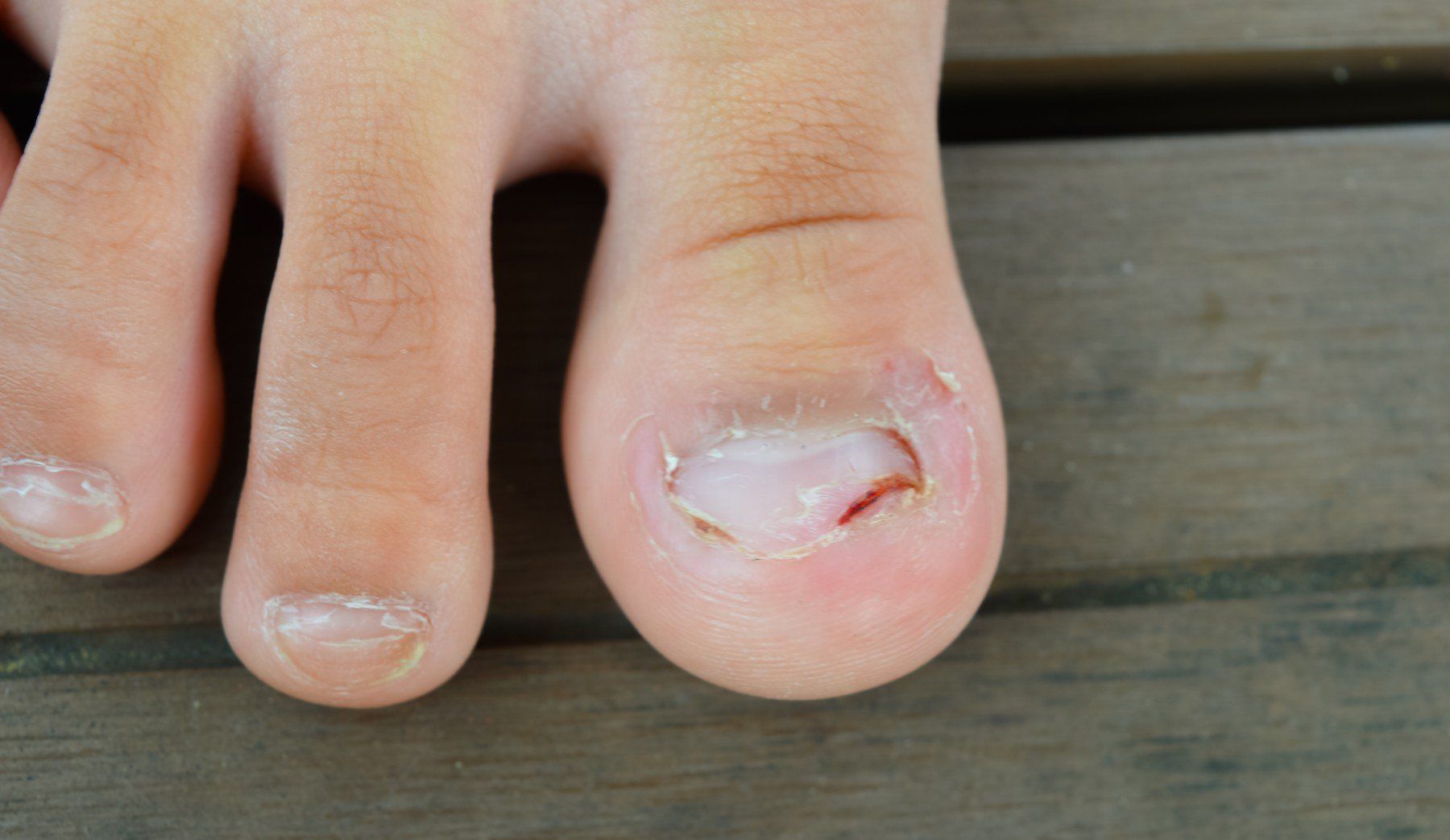 close-up-leg-with-fungus-nails-onycholysis-exfoliation-nail-from-nail-bed