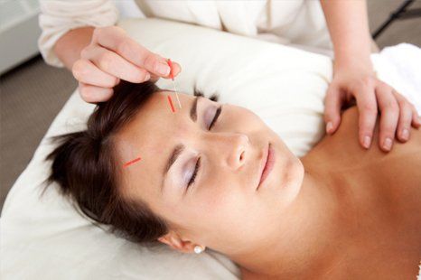 acupuncture treatment for headache