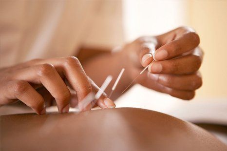 acupuncture fro shoulder pain