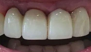 Close-up of four bright white dental crowns in a mouth, with visible gums and lower teeth.