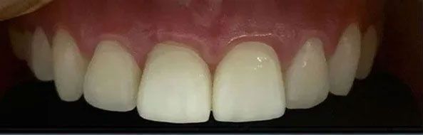 Close-up view of a set of white, healthy-looking teeth against pink gums.