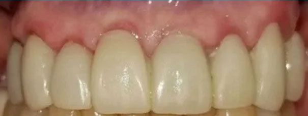 Close-up of a person's upper teeth, which appear to be clean, and a pale yellow-white color.