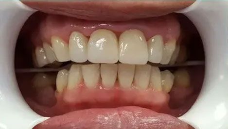 Teeth in a mouth, held open by a dental retractor. Upper teeth are whiter than lower.