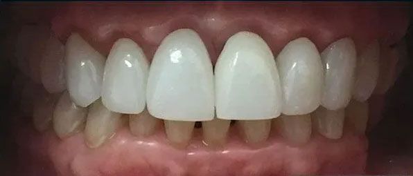 Close-up of human teeth, showing a bright, white smile.