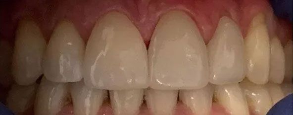 Close-up view of teeth, mostly white with a yellowish tooth. Pink gums surround the teeth.