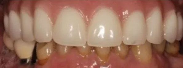 Close-up of teeth. Front teeth are bright white; back teeth are yellowed. Gum is pink.