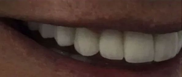 Close-up of a smiling mouth with bright white teeth, visible against the skin.