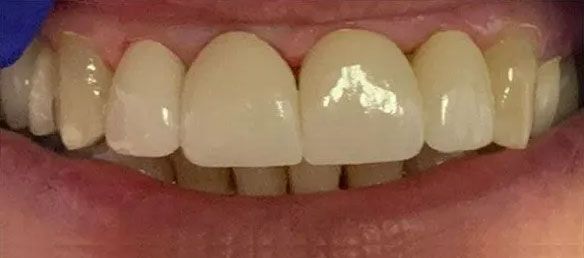 Close-up of a person's teeth. Bright white front teeth with a few visible, discolored teeth behind them.