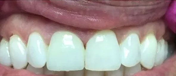 Close-up of a person's teeth. They are white and appear healthy. The gums and lip are visible.