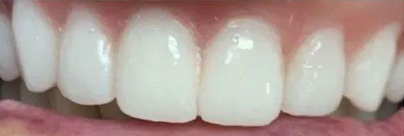 Close-up of a person's upper teeth, showing bright white, evenly spaced teeth.