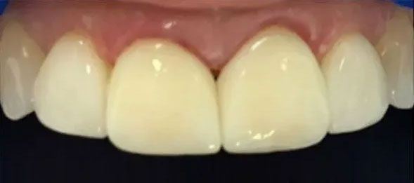 Close-up of a person's teeth. They are bright white and even, with a slight gleam. Pink gums are visible.