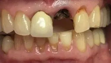 Mouth with decayed and damaged teeth; one tooth missing, others stained and broken.