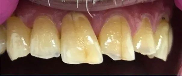Close-up of teeth, displaying a chipped front tooth. The teeth are yellowish with visible imperfections.