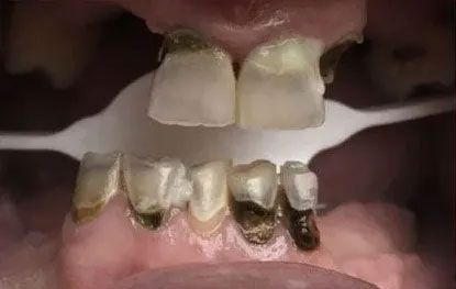 Mouth with teeth severely stained and decayed, a dental tool is present.