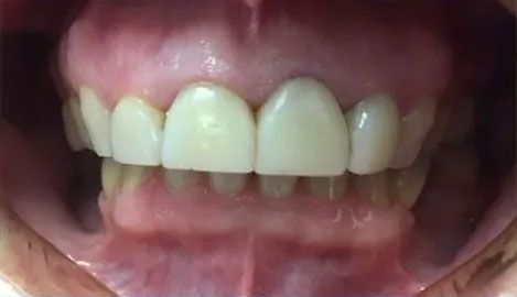 Close-up view of a person's open mouth, showing teeth and gums. The top teeth are visible.