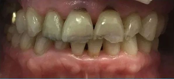 Close-up of teeth with discoloration, some damage, and slight gaps. Gum tissue is visible.