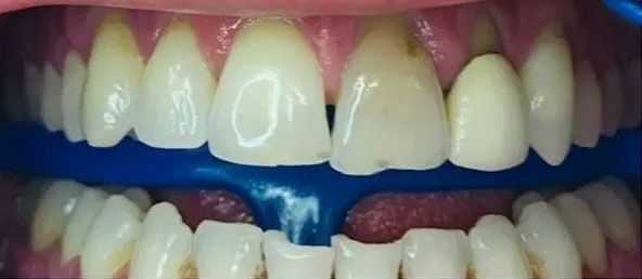 Close-up of teeth with a blue rubber dam. Some teeth have light-brown staining.