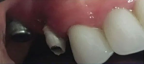 Close-up of a mouth showing a dental implant, tooth, and gum tissue.