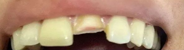 Close-up of a person's teeth, with a chipped front tooth. The teeth are yellowed, and the gums are visible.