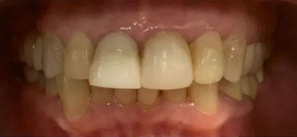 Close-up of a person's upper teeth. Two front teeth are capped, the others are yellowish. The gums are pink.