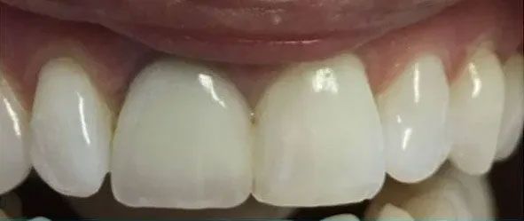 Close-up of bright white teeth, in a healthy, clean mouth, with pink gums visible.