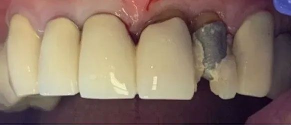 Close-up of teeth, one with a gray filling, the others are a natural shade.