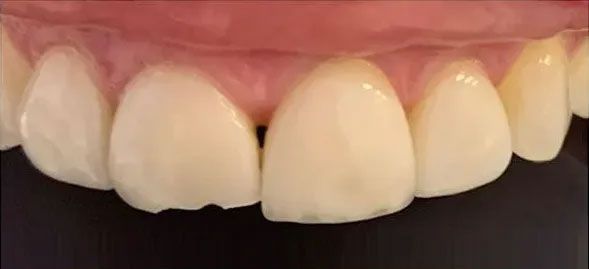 Close-up of teeth, some with minor chips, against a dark background. Gumline is visible.