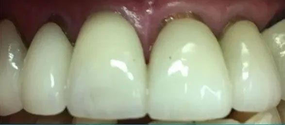 Close-up of human teeth; the front teeth are covered with a white covering with the gums visible above.