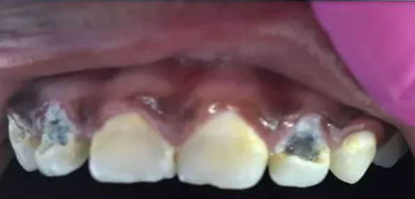 Close-up of teeth with dark fillings and yellowing, inside a mouth, visible gums.
