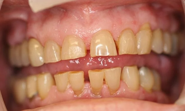 Close-up of a person's teeth showing yellowed teeth with a visible gap between the two front teeth.