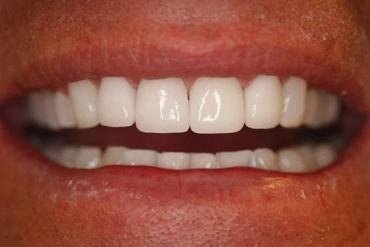 Close-up of a person's bright white teeth in a smiling mouth. Lips are pink and skin is peach-toned.
