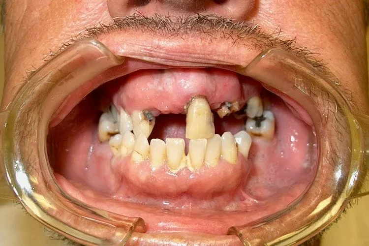Mouth with several missing and damaged teeth; dental retractor in place.