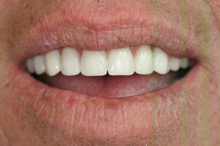 Close-up of a person's smiling mouth showing a complete set of bright white teeth.