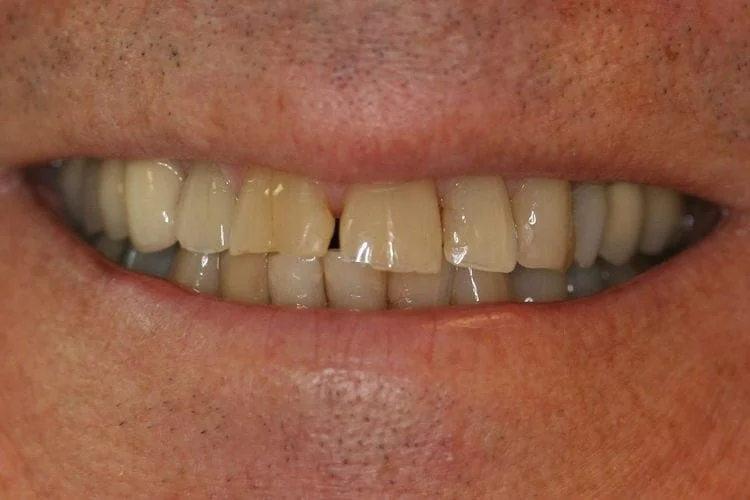 Close-up of a person's smile, showing teeth with a prominent gap and discoloration.