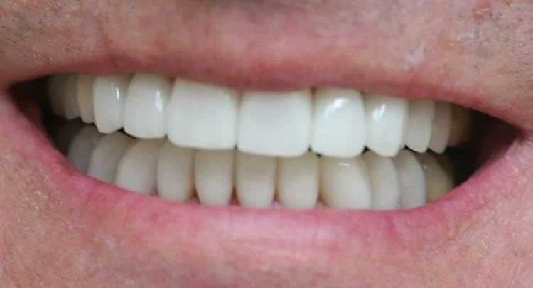 Close-up of a person's mouth with bright, white teeth visible in a smiling expression.