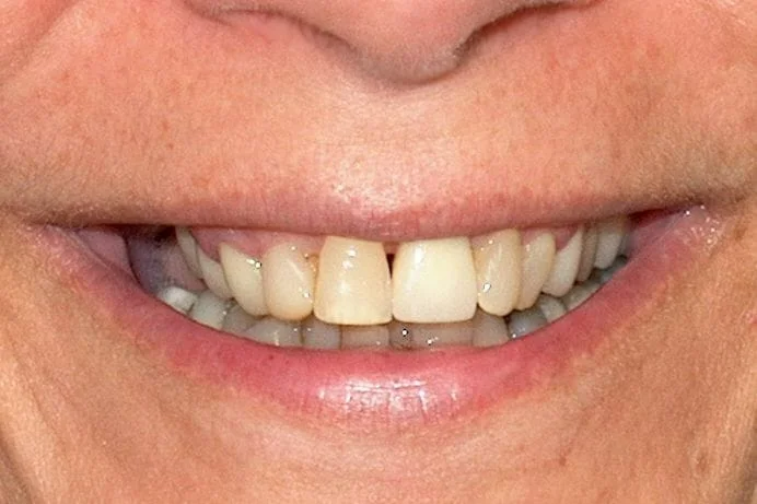 Close-up of a person's smiling mouth showing teeth with a prominent gap and slightly yellowed color.