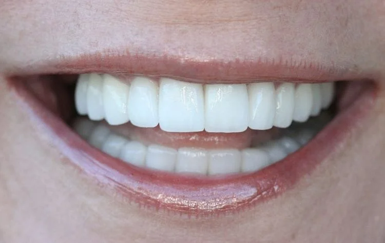 Close-up of a smiling mouth with bright white, straight teeth. Pink lips are slightly parted.