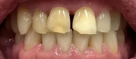 Close-up of teeth. One front tooth is yellowed and chipped. The others are mostly white.