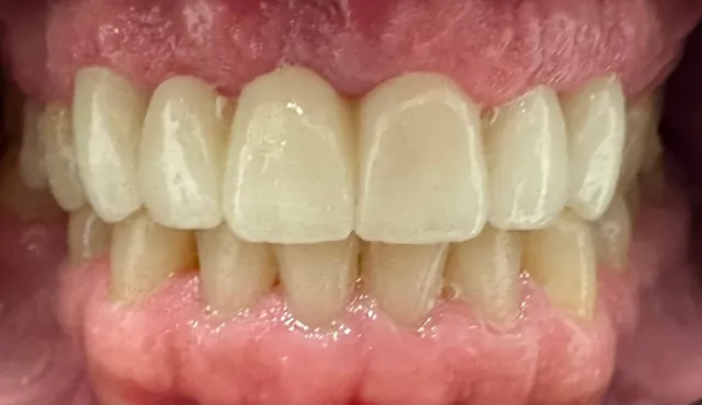 Close-up view of teeth showing the upper and lower arches; the top teeth are lighter than the bottom teeth.