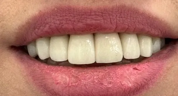 Close-up of a person's smiling mouth showing white teeth and pink lips with lipstick.