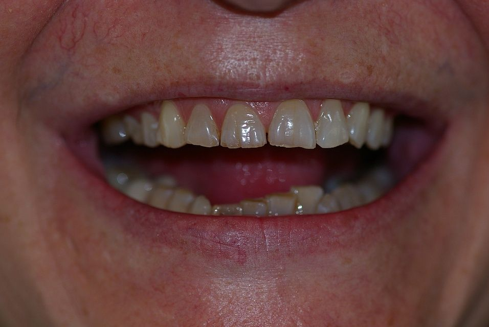 Close-up of a person's open mouth, showing teeth. Some teeth are slightly yellowed.