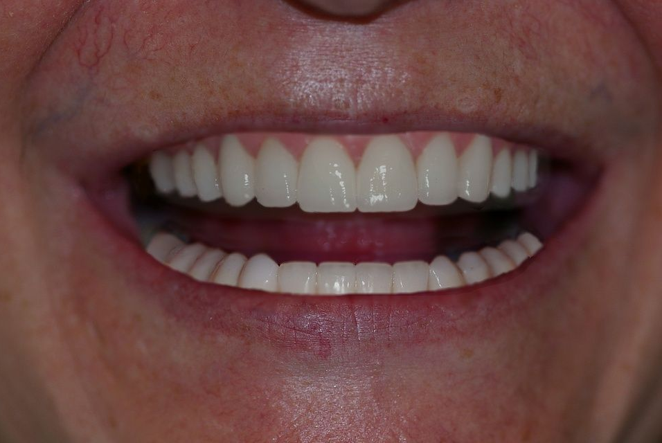 Open mouth displaying a set of bright, white teeth; pink gums visible; skin around mouth.
