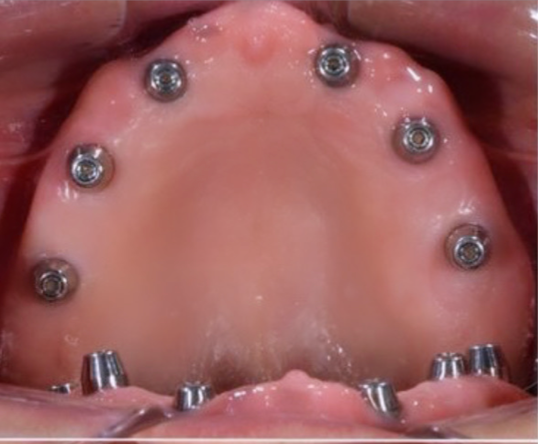 Un primer plano de la boca de una persona con tornillos en ella.