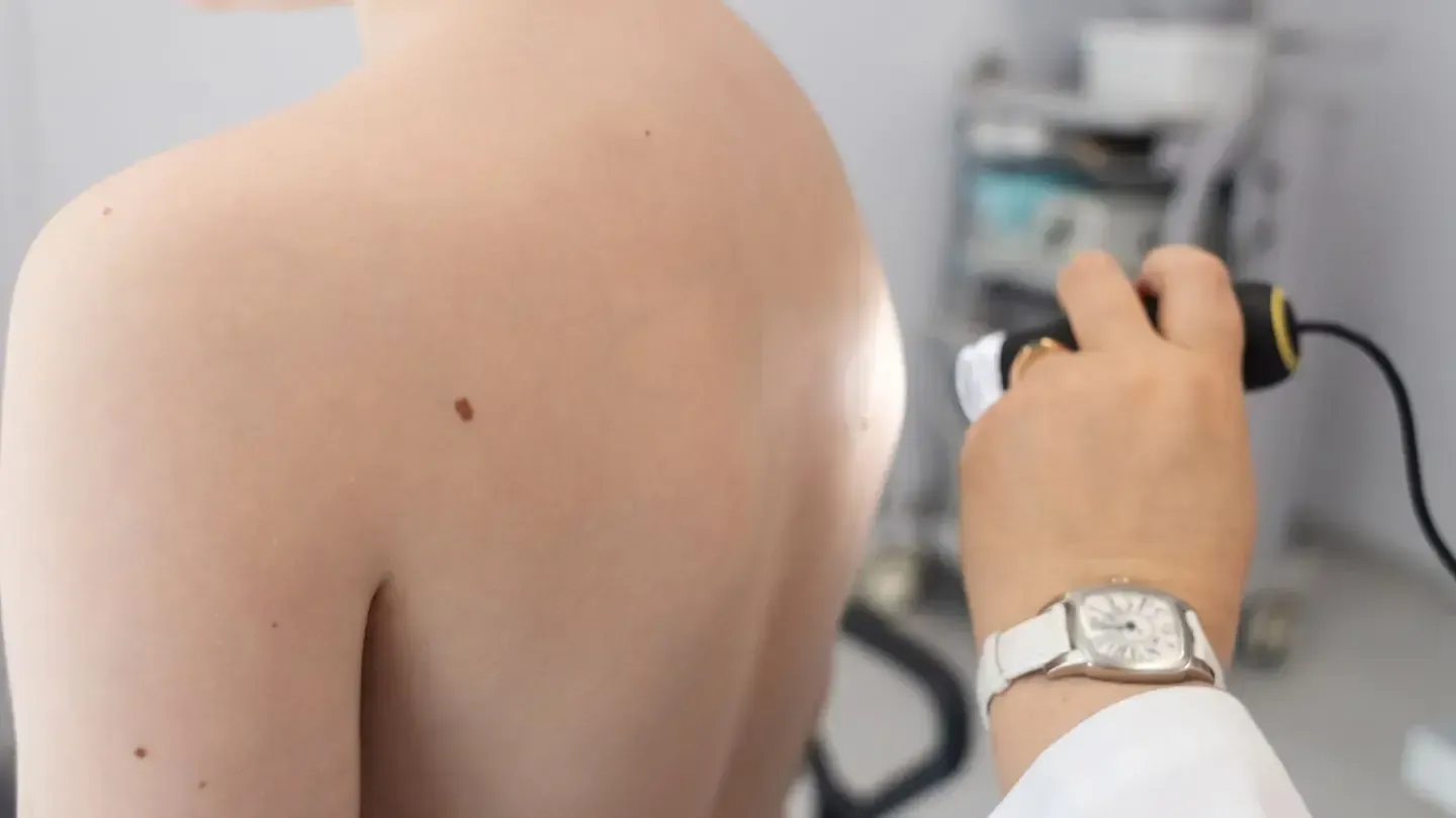 Doctor examining a mole on a patient's back with a handheld device.