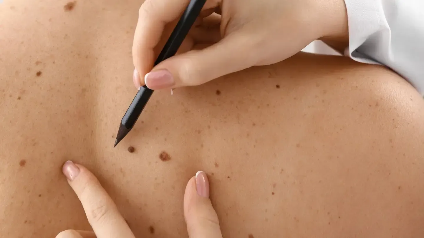 A medical professional examines moles on a person's back, marking one with a pen.